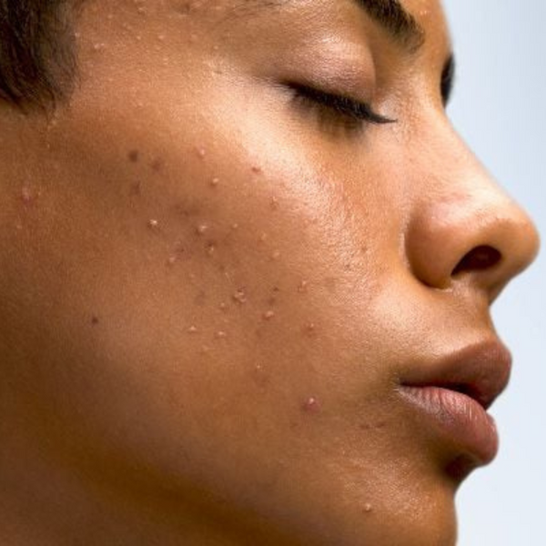 Oily/Acne Prone Skin